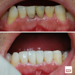 caso de implantes dentales y carillas