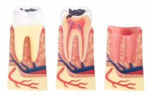 caries dental