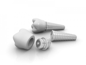 implantes dentales Gijón