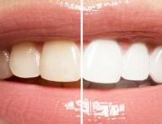 blanqueamiento dental gijon asturias