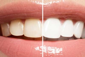blanqueamiento dental gijon asturias