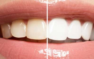 blanqueamiento dental gijon asturias