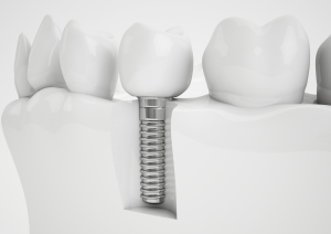 implantes dentales
