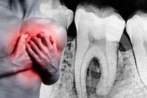 periodontitis corazón