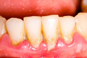 placa bacteriana