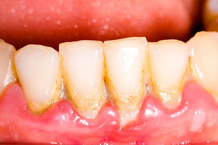 ¿Cómo quitar el sarro de los dientes? – Clínica Dental Vinateros