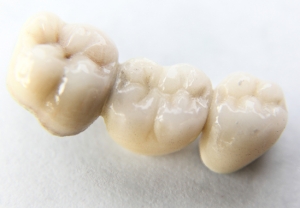 puentes dentales