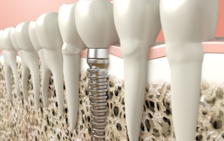 regeneracion osea implantes dentales