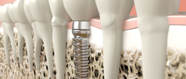 regeneracion osea implantes dentales