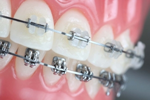 ortodoncia con brakets gijon