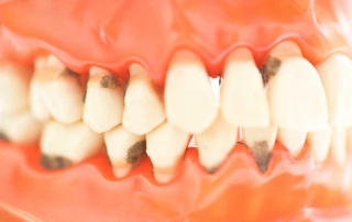 tratamiento periodoncia gijon