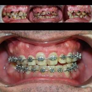 caso ortodoncia clinica dental gijon dr arias