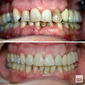 caso de periodontitis y estética dental