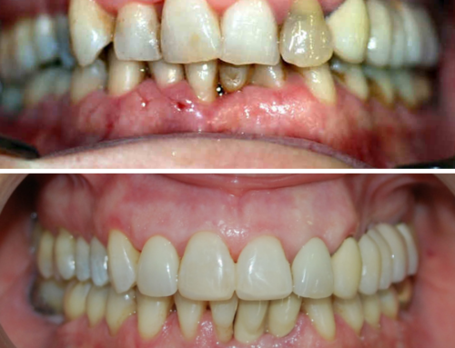 Caso de periodontitis y estética dental