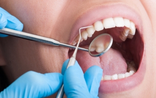 limpieza dental en clinica gijon
