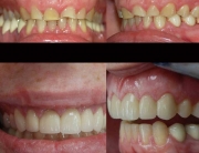 bruxismo desgaste dental y reconstruccion clinica odontologica integral Dr. Arias Gijón