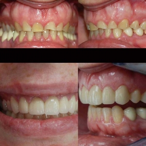 bruxismo desgaste dental y reconstruccion clinica odontologica integral Dr. Arias Gijón