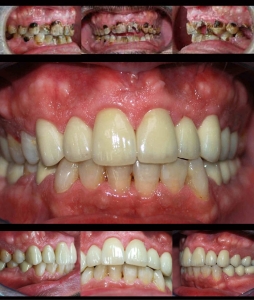 Caso de caries rampante Clínica Odontológica Integral Gijón