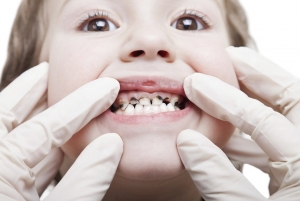 niño con caries