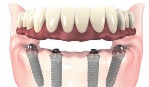 implantes dentales all on four gijon