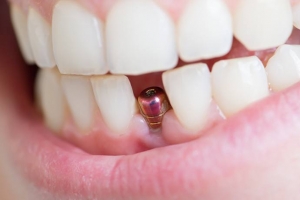 implante dental
