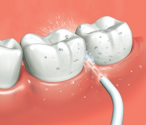 irrigador dental