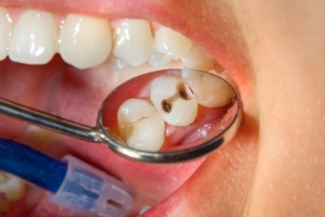 caries dental