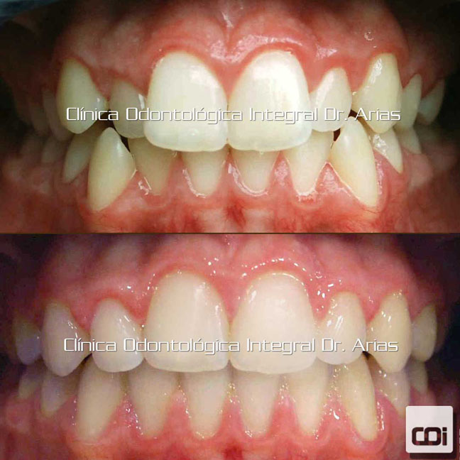 antes y despues ortodoncia imagen frontal