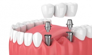 implantes carga inmediata Gijón