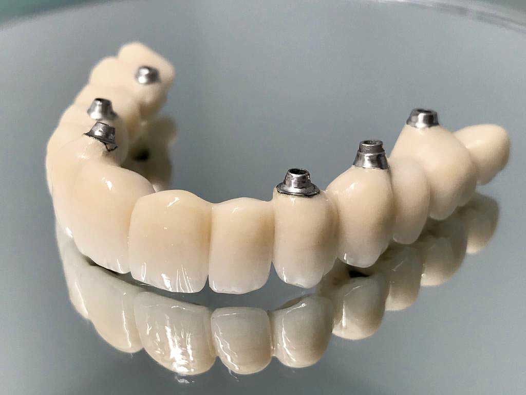 Cuanto cuesta poner implantes en toda la boca