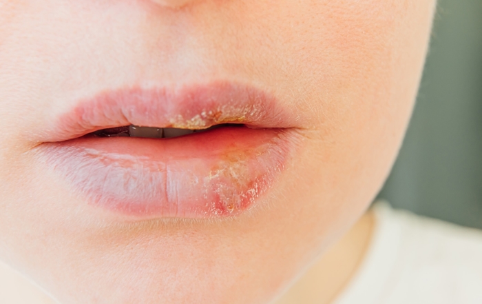 Tratamiento láser del herpes labial