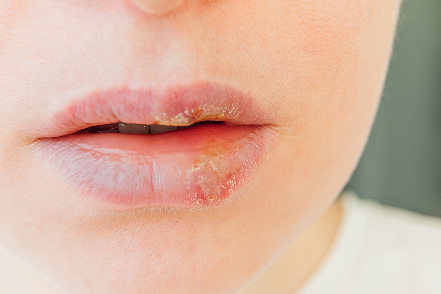 water blister on lips - pictures, photos