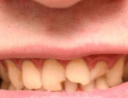 fracturas dentales