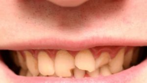 fracturas dentales