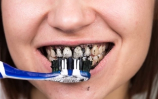 blanqueamiento dental carbón activado