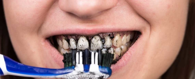 blanqueamiento dental carbón activado