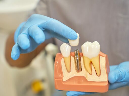 implante-dientes-dental-clinica-odontologica-en-gijon-asturias-humberto-arias-1