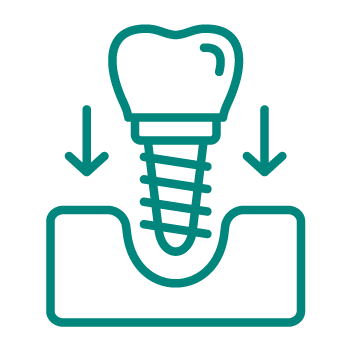 implantes-dentales-de-excelente-calidad-en-gijon-profesional